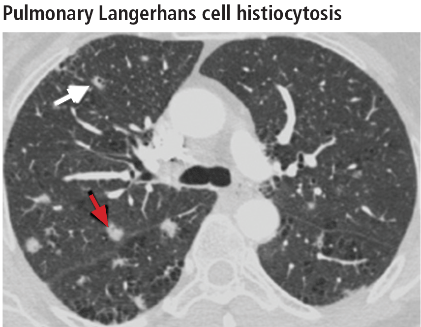 Pulmonary Langerhans cell histiocytosis