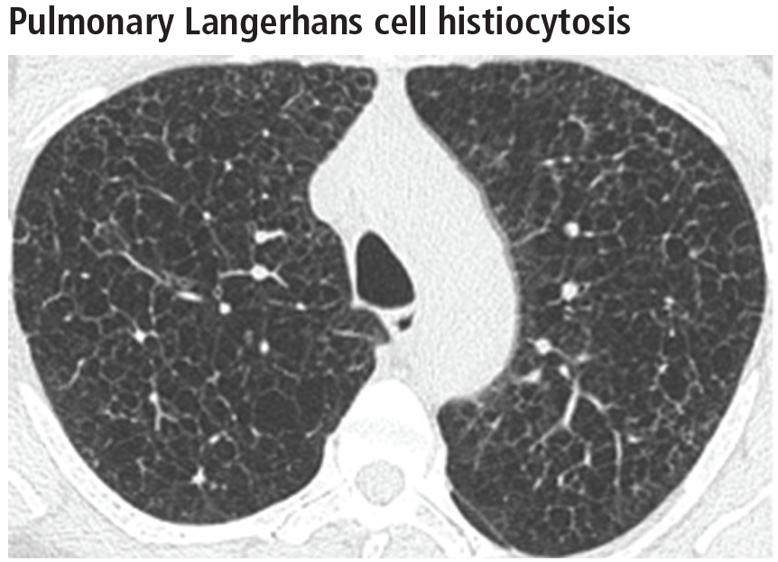 Pulmonary Langerhans cell histiocytosis