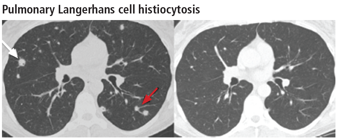 Pulmonary Langerhans cell histiocytosis