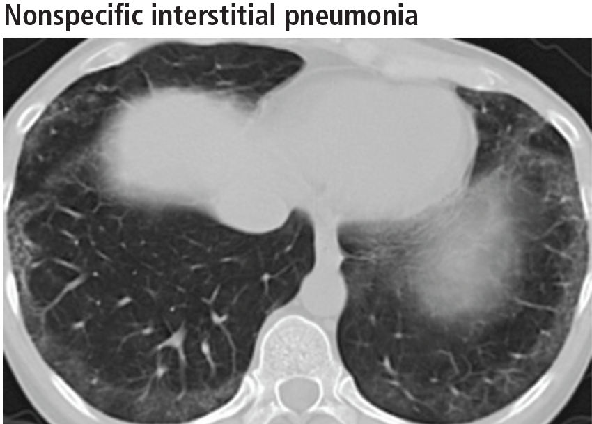 Nonspecific interstitial pneumonia