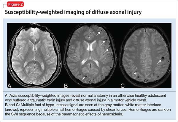 Susceptibility-weighted imaging of diffuse axonal injury