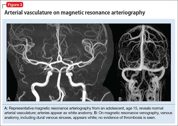 Arterial vasculature on magnetic resonance arteriography