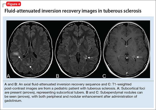 Fluid-attenuated inversion recovery images in tuberous sclerosis