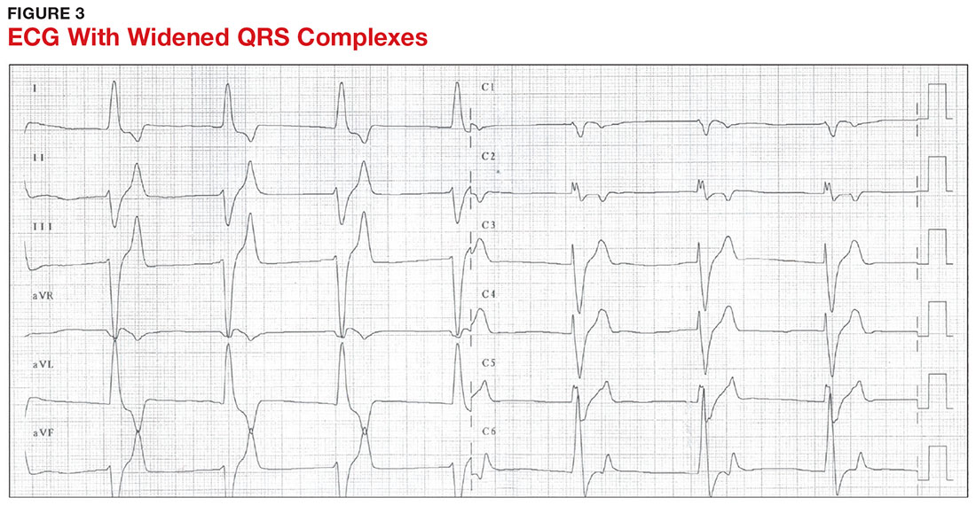 ECG With Widened QRS Complexes image