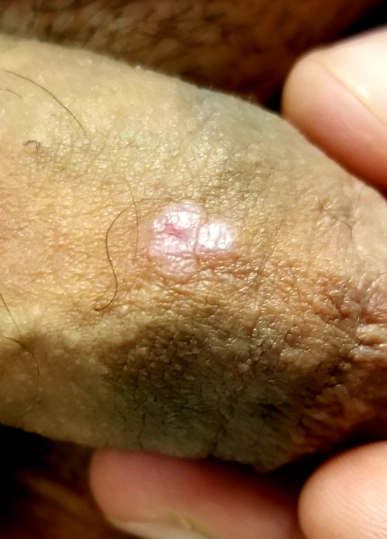 wart treatment elbow)