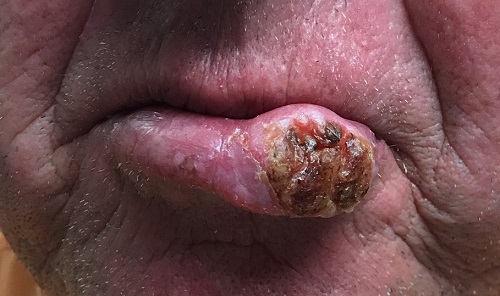 Lip lesion