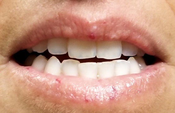 Red vascular streaks on upper and lower lips