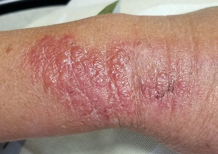 Poison ivy on arm