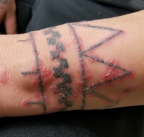 Was This Tattoo a Rash Choice? | Clinician Reviews
