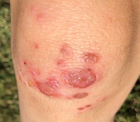 Knee lesions