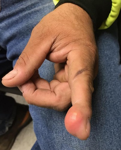Finger lesion