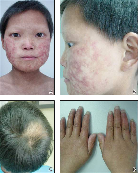 A Case Of Bloom Syndrome With Uncommon Clinical Manifestations Confirmed On Genetic Testing 