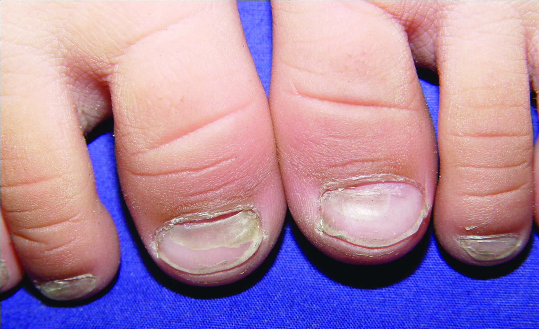 Lindsay nails • LITFL • Medical Eponym Library