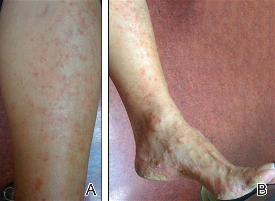 pityriasis-lichenoides-chronica-presenting-with-bilateral-palmoplantar