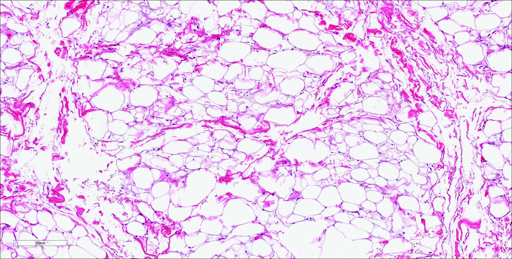 spindle cells and ropey collagen- found in spindle cell lipomas
