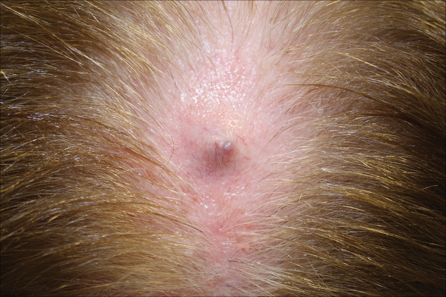 Firm Gray Nodule on the Scalp | MDedge Dermatology