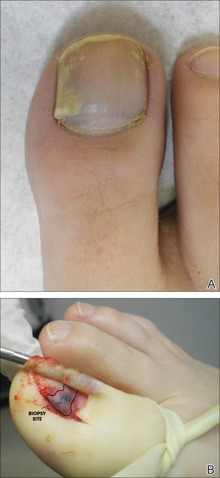 Subungual Onycholemmal Cyst Of The Toenail Mimicking Subungual Melanoma Mdedge Dermatology