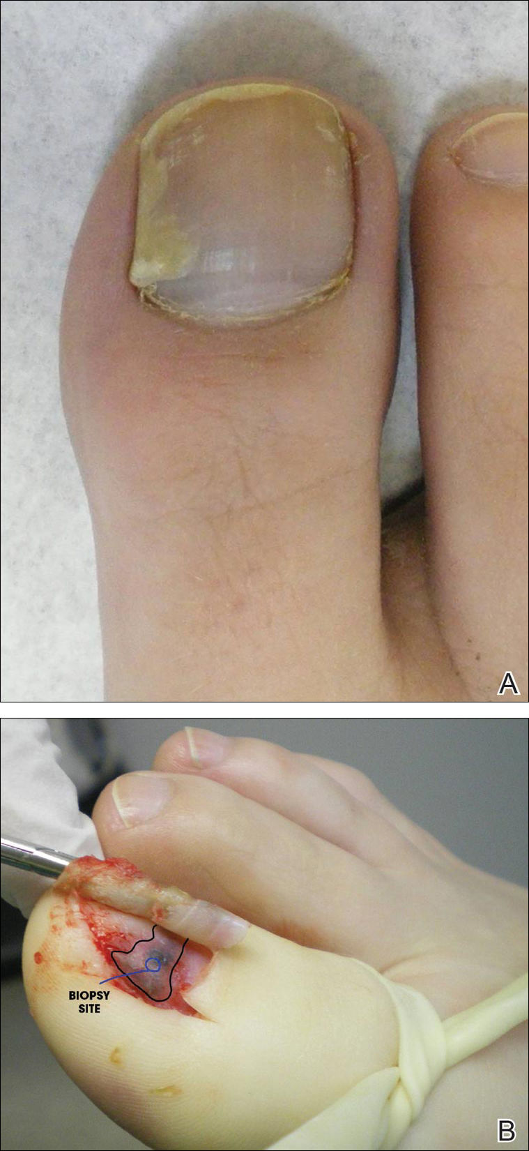 Nail matrix/bed specimen. (A) Longitudinal lesion with distal... | Download  Scientific Diagram