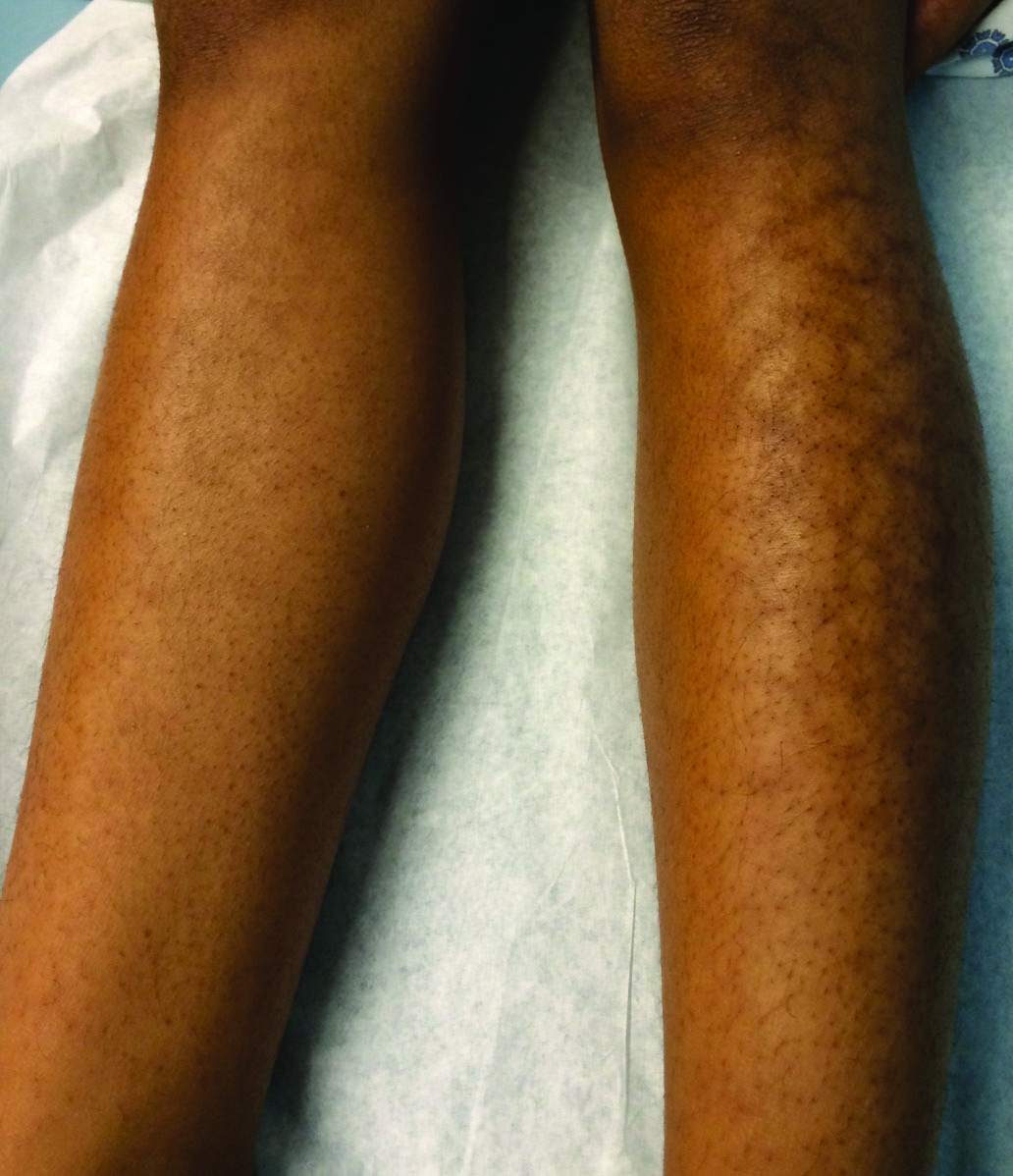 Reticular Hyperpigmentation on the Lower Legs | MDedge Dermatology
