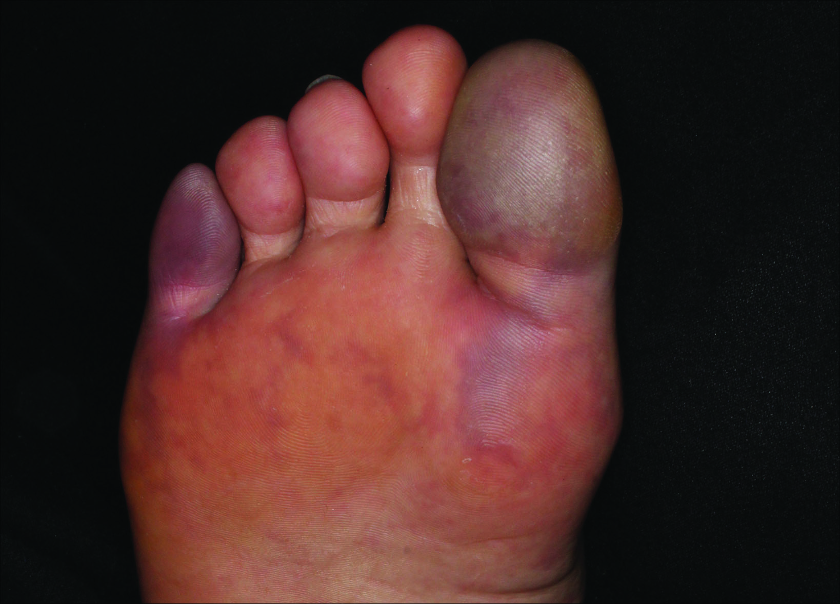 Painful Purple Toes Mdedge Dermatology