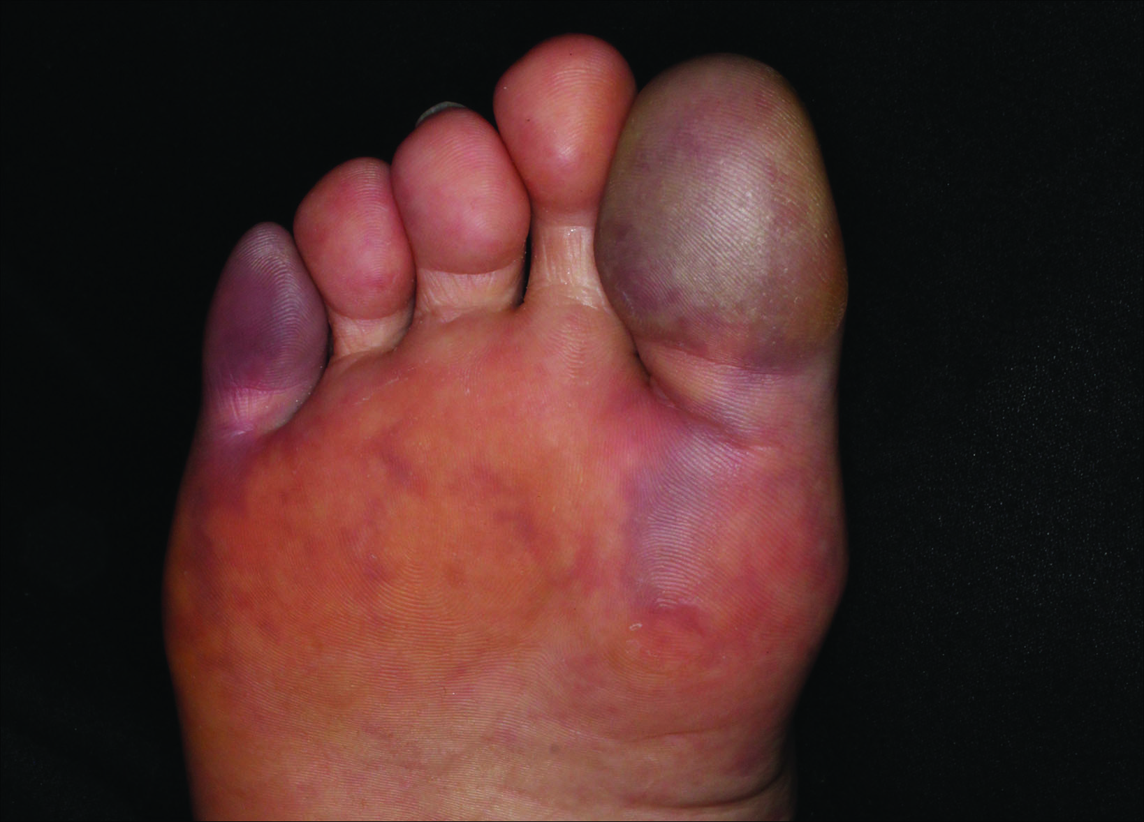 painful-purple-toes-mdedge-dermatology