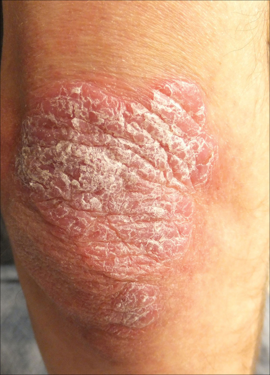 Dry Scaly Bumps On Skin 