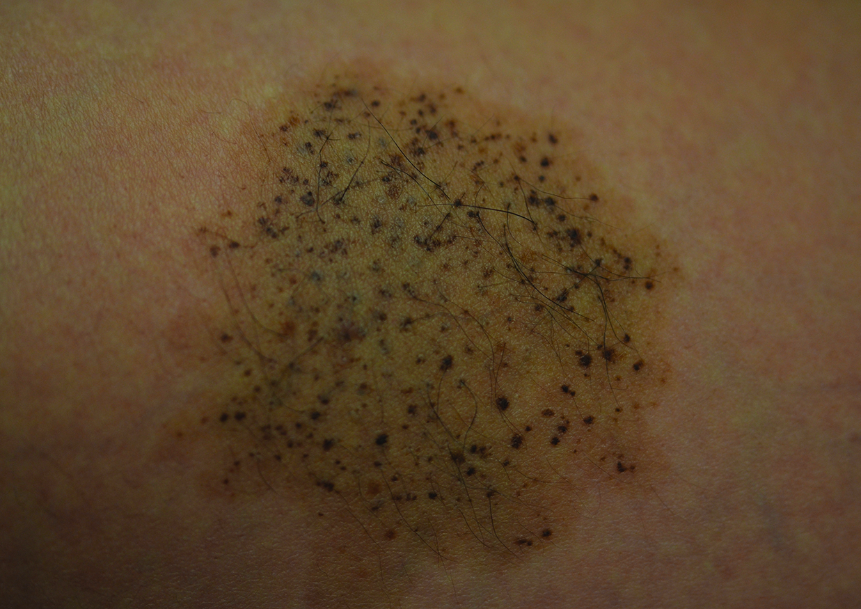 Nevus Spilus Is the Presence of Hair Associated With an Increased Risk