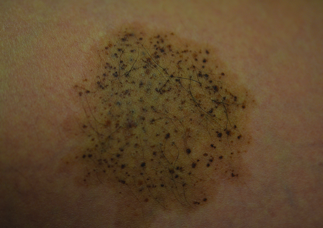 nevus-spilus-is-the-presence-of-hair-associated-with-an-increased-risk