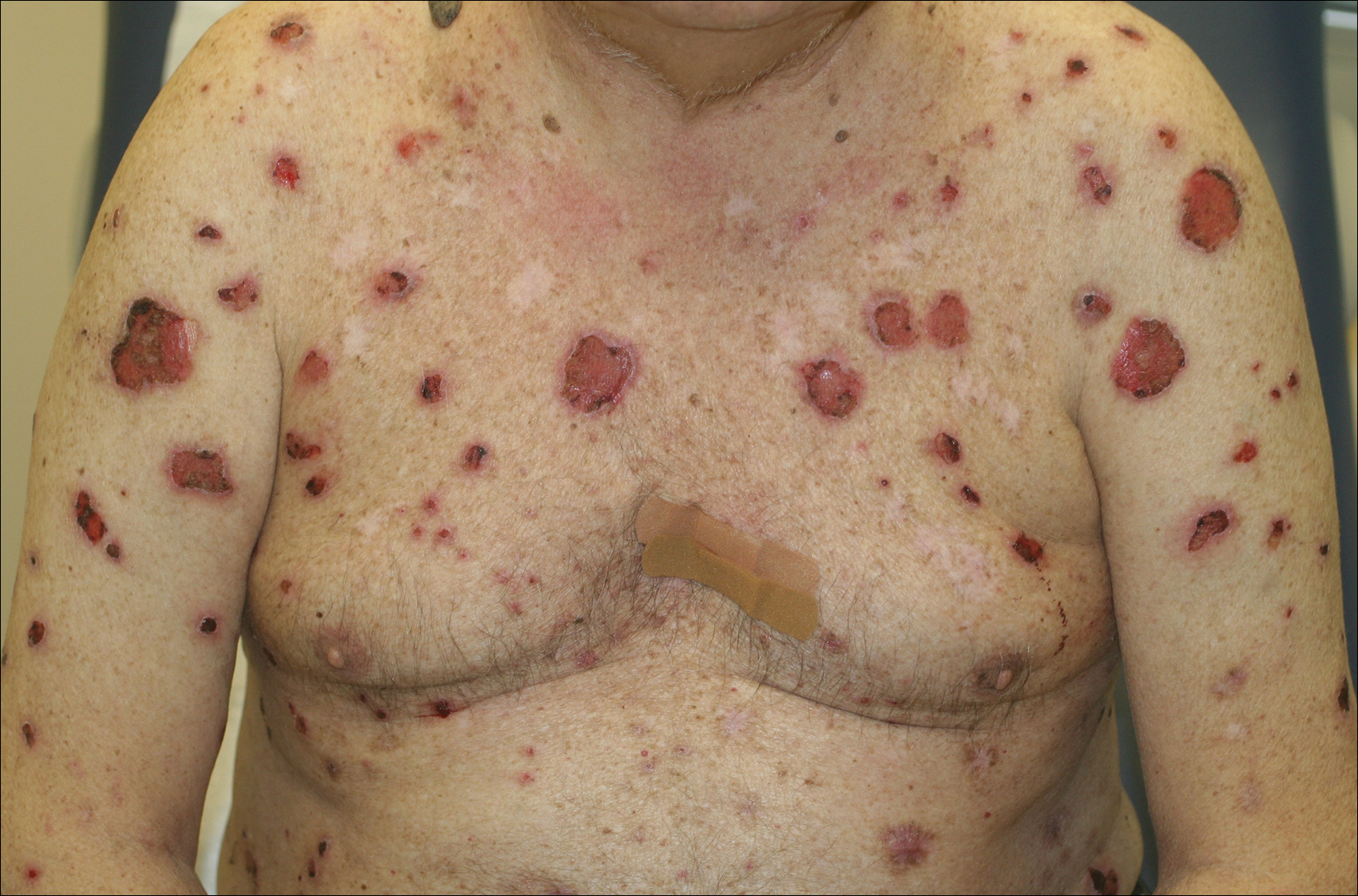 bullous pemphigoid