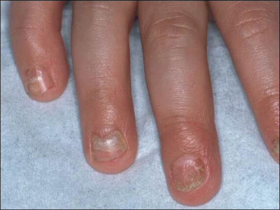 fingernail diseases