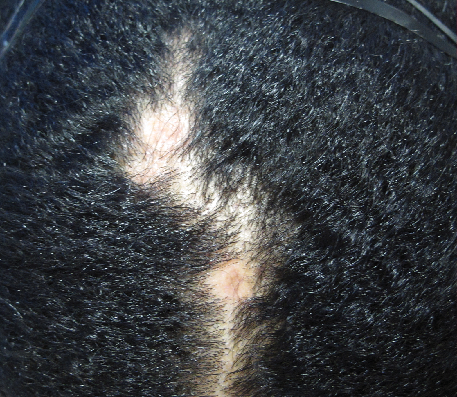 Lupus Erythematosus Tumidus of the Scalp Masquerading as Alopecia Areata |  MDedge Dermatology