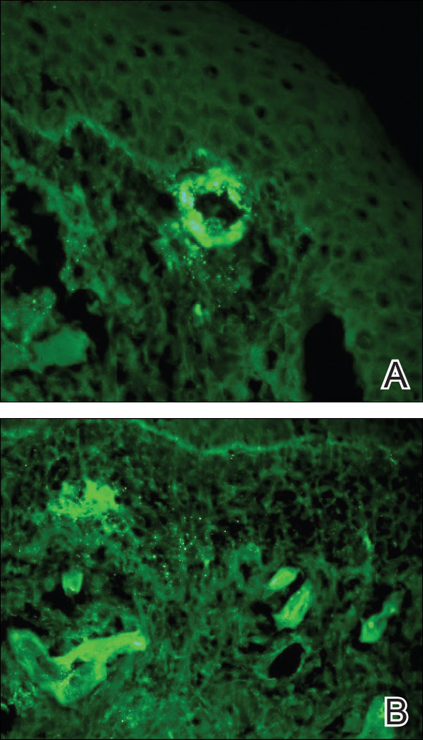 Postoperative Henoch Schönlein Purpura Mdedge Dermatology