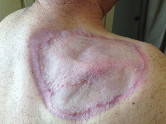 basal cell carcinoma early stages chest