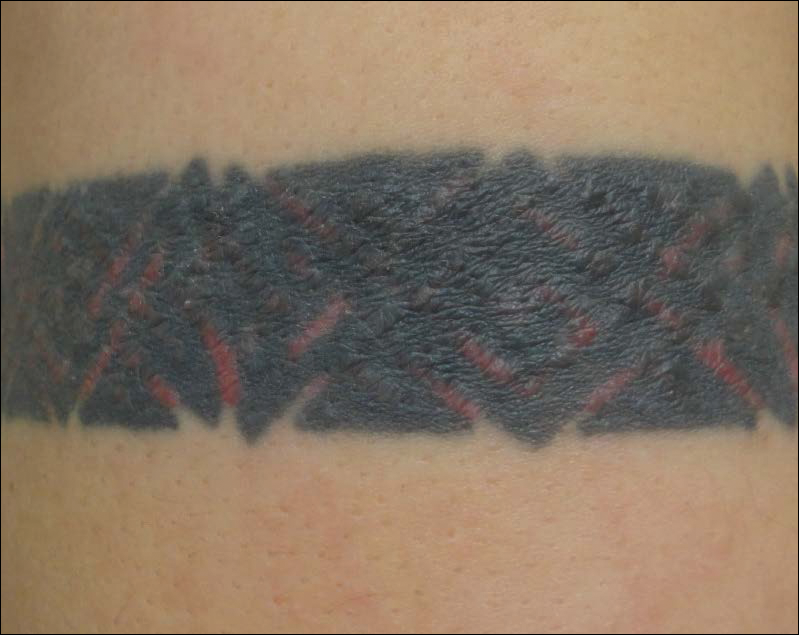 Id Reaction Associated With Red Tattoo Ink | MDedge Dermatology