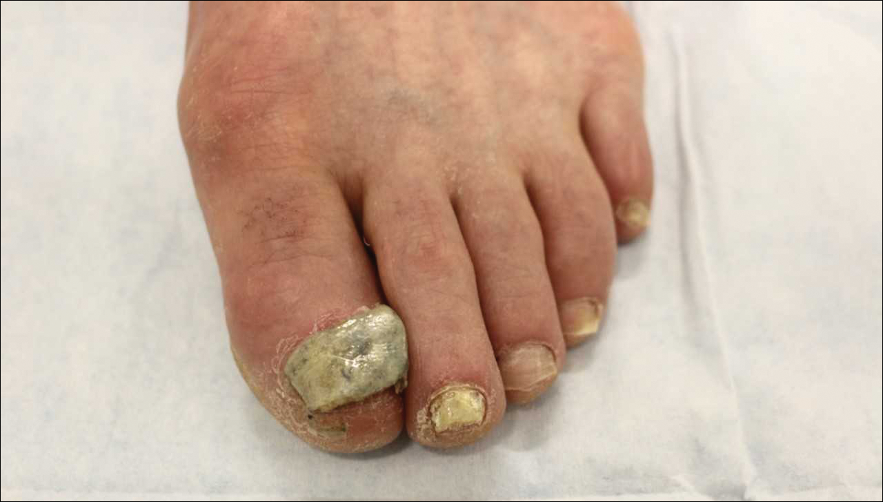 PPT - ONYCHOMYCOSIS & LOCERYL NAIL LACQUER PowerPoint Presentation -  ID:4032605