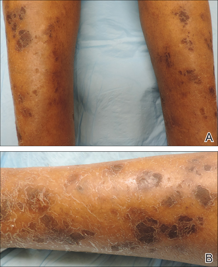 JCM | Free Full-Text | Pathogenesis, Diagnosis and Management of Squamous  Cell Carcinoma and Pseudoepithelial Hyperplasia Secondary to Red Ink Tattoo:  A Case Series and Review