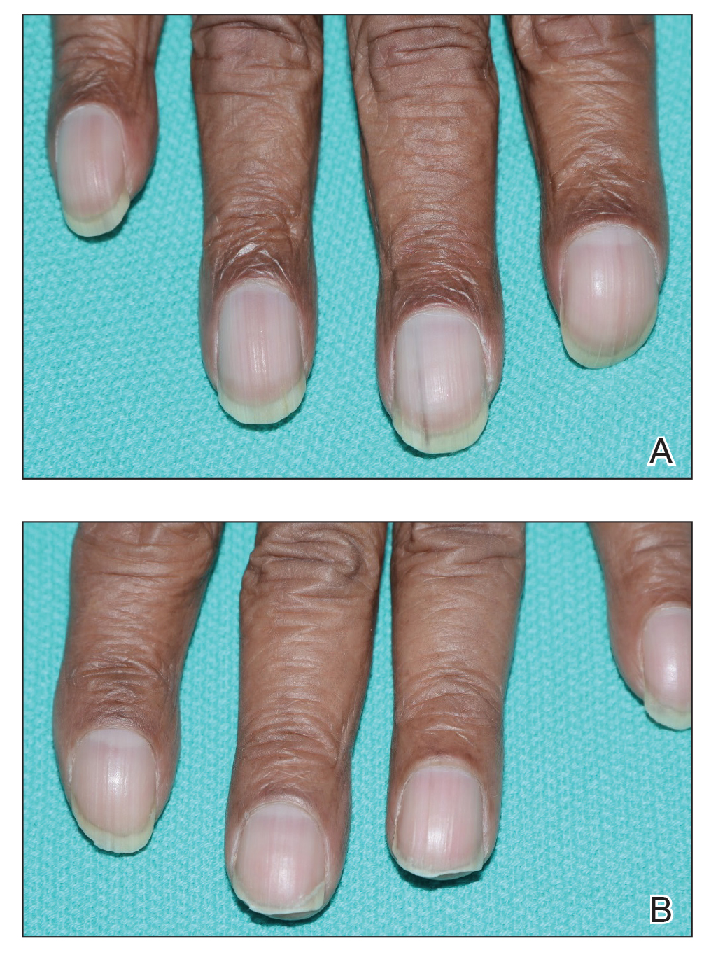 Unilateral Nail Clubbing in a Hemiparetic Patient | MDedge Dermatology