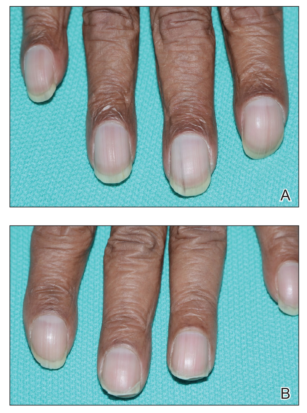 Unilateral Nail Clubbing In A Hemiparetic Patient Mdedge Dermatology