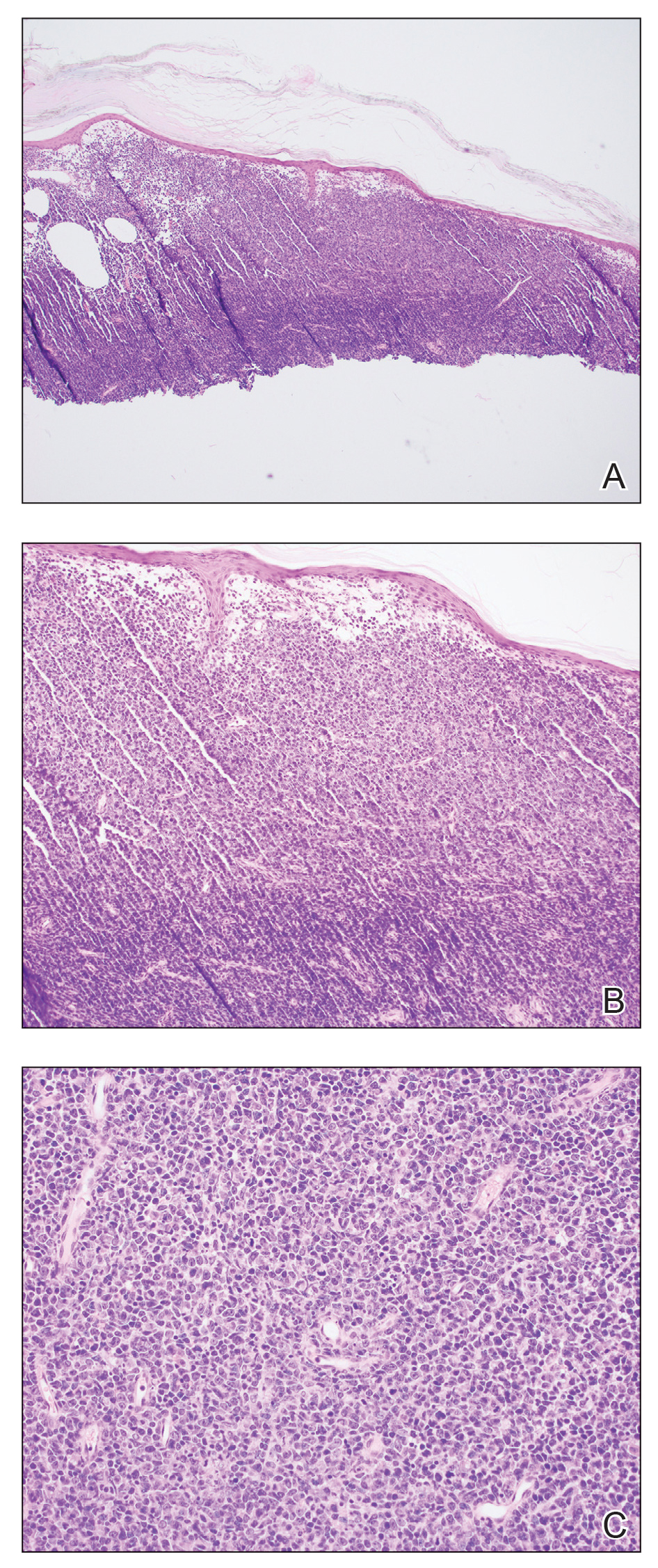 A shave biopsy of the largest lesion revealed a dense, diffuse, atypical lymphoid infiltrate consisting predominantly of large-sized lymphoid cells with fine chromatin and conspicuous nucleoli occupying the entirety of the dermis