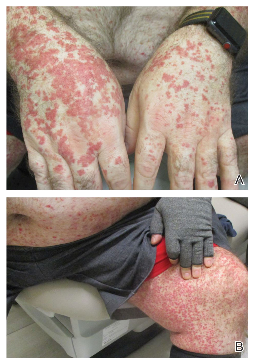 A and B, Numerous purpuric thin papules coalescing in plaques on the dorsal hands and left medial thigh.