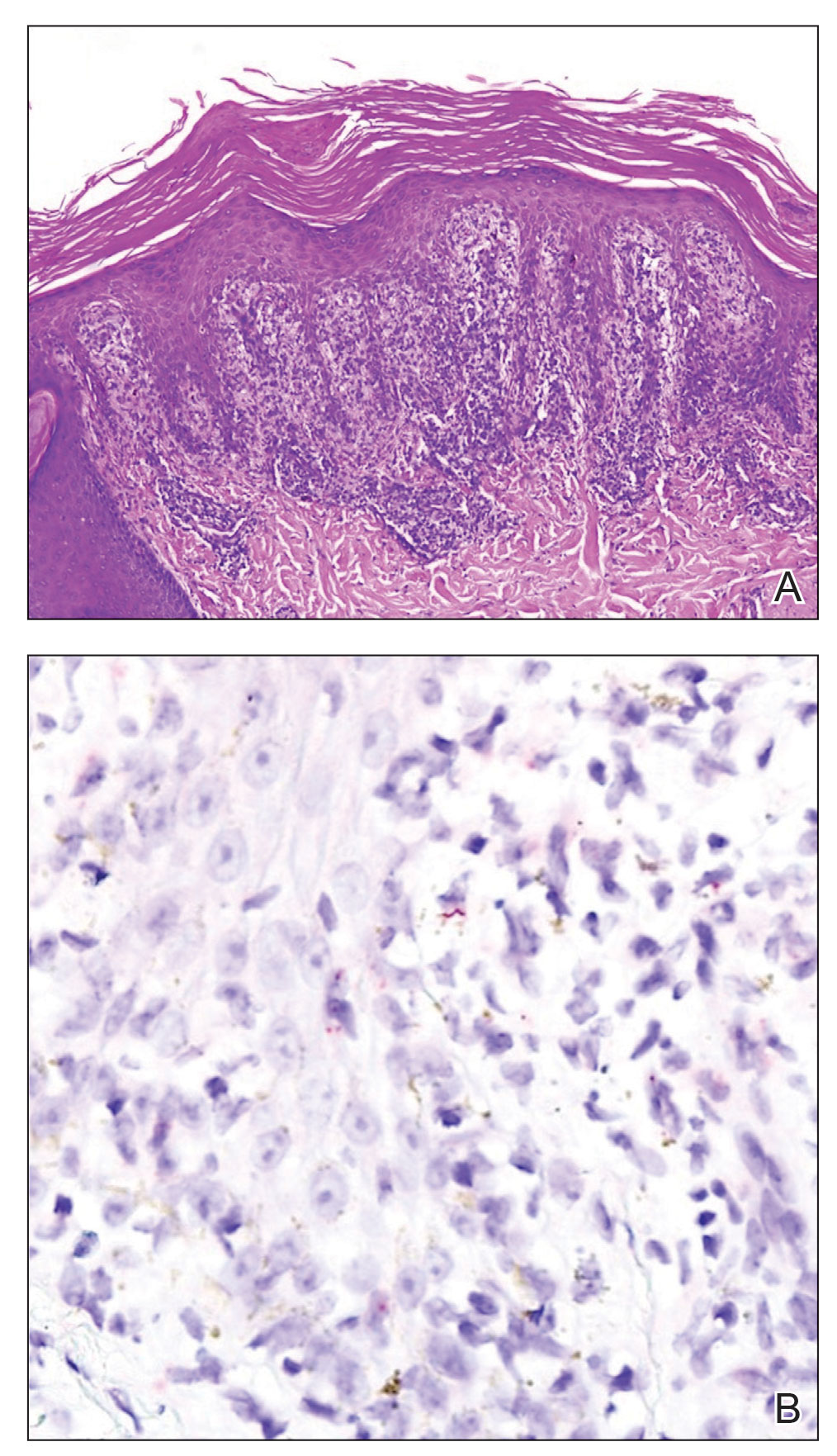 Histopathology demonstrated an interface dermatitis with psoriasiform hyperplasia and overlying parakeratosis