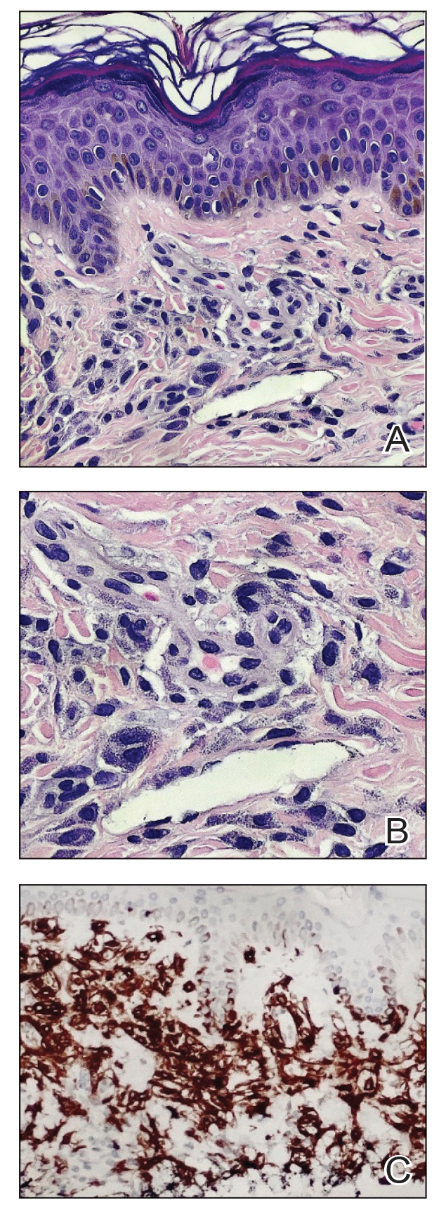 A, Histopathology revealed dermal perivascular aggregates of mast cells (H&E, original magnification ×200). B, Higher magnification demonstrated the typical basophilic granular cytoplasm and the bland round-oval dark basophilic nuclei of mast cells