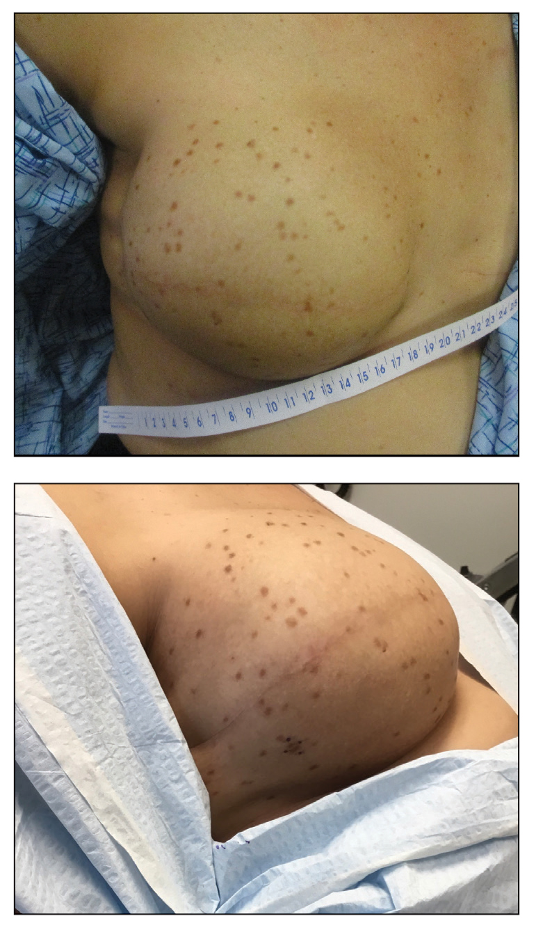 Diffusely scattered macules following radiation therapy 