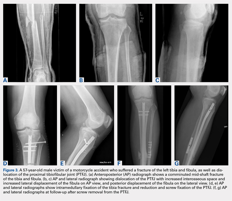 A 57-year-old male victim of a motorcycle accident who suffered a fracture of the left tibia and fibula