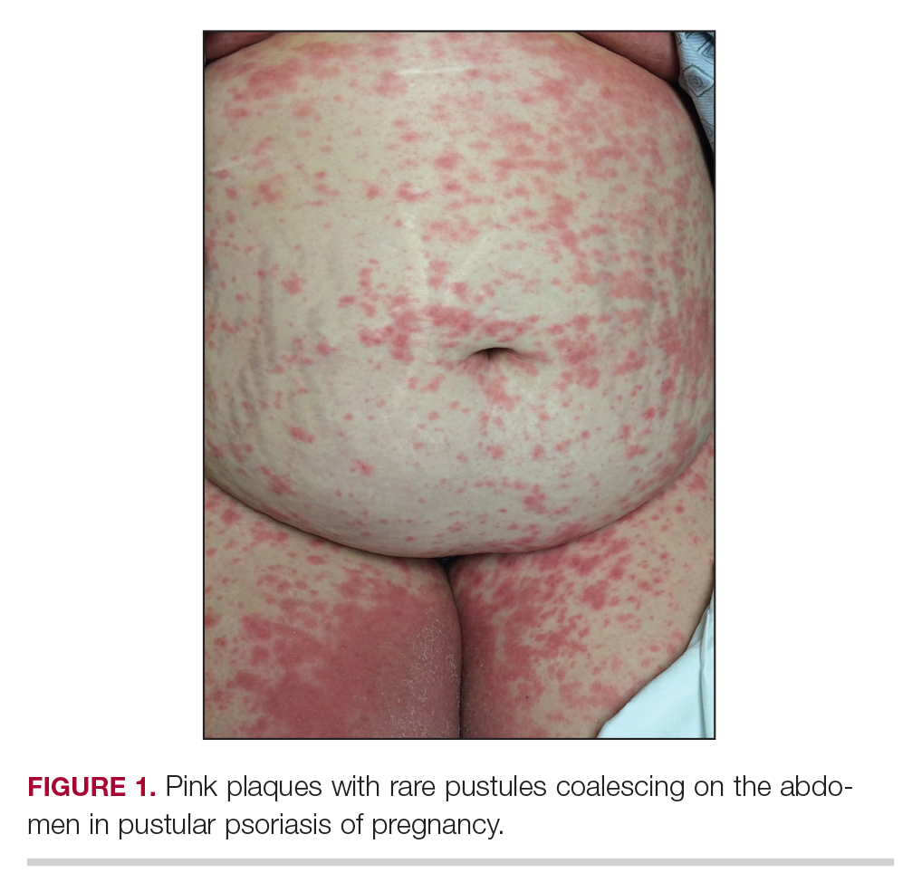 psoriasis cleared up during pregnancy)