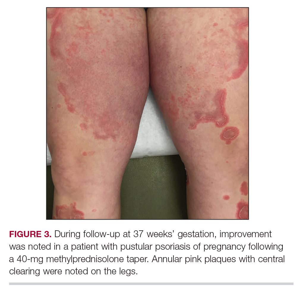 Developing psoriasis during pregnancy