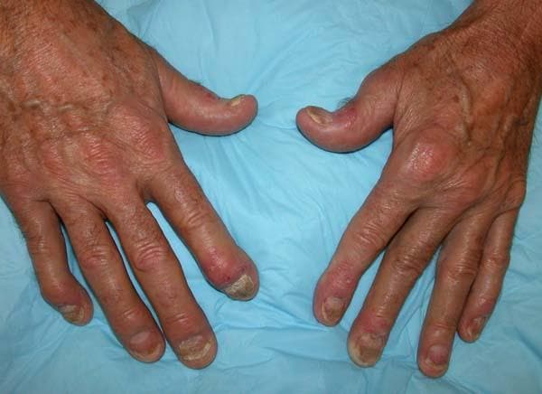Can homeopathy help your Psoriatic arthritis ?