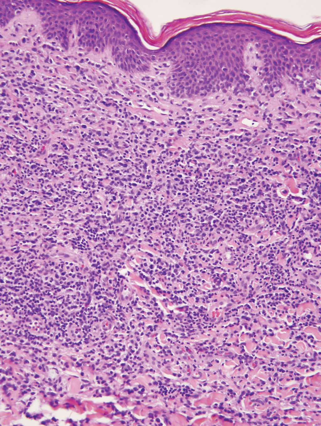 Cutaneous γδ T-cell lymphoma