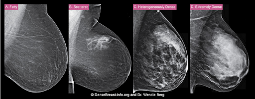 BI-RADS® breast composition categories