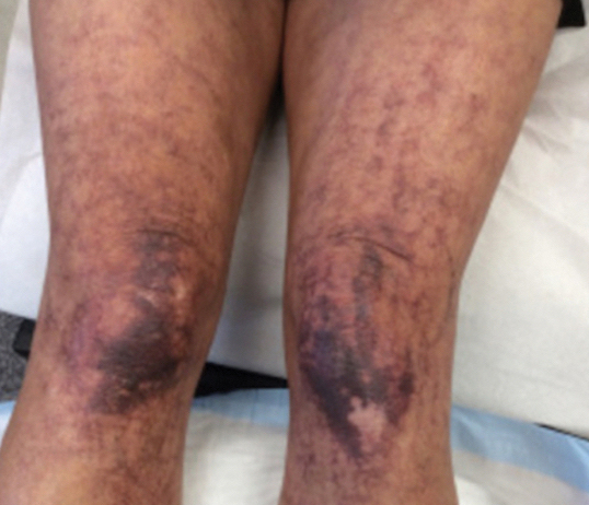 Purple telangiectasia with macules coalescing into patches on the legs.